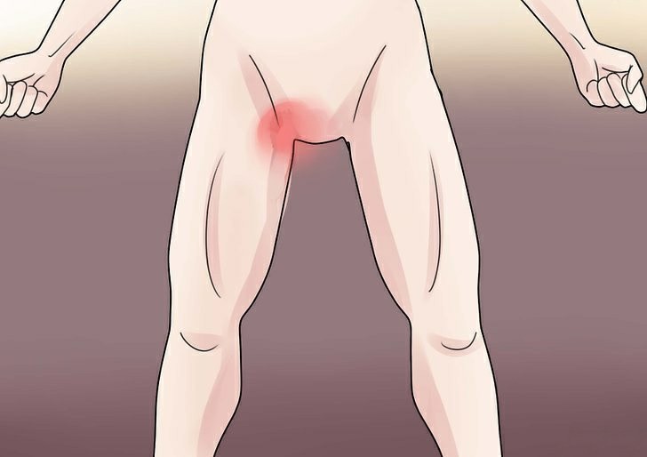 Micose na virilha: quais as causas, principais sintomas e tratamentos