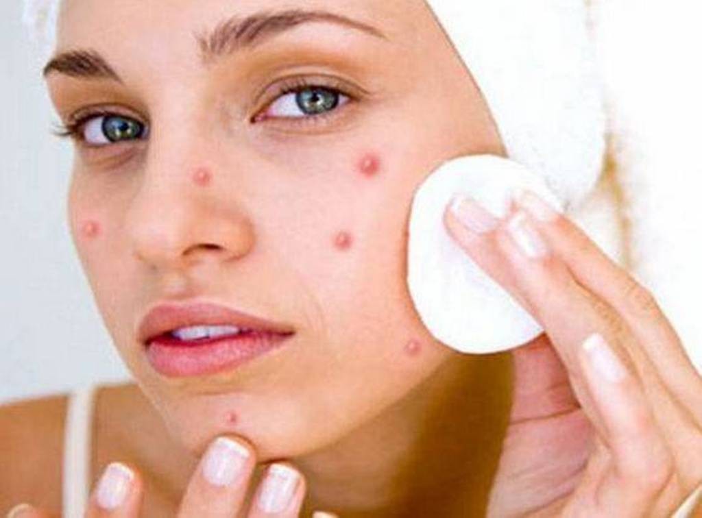16 remédios naturais para eliminar a acne de forma simples: receitas e dicas