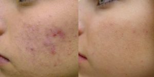 remédios naturais para eliminar a acne