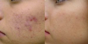 remédios naturais para eliminar a acne