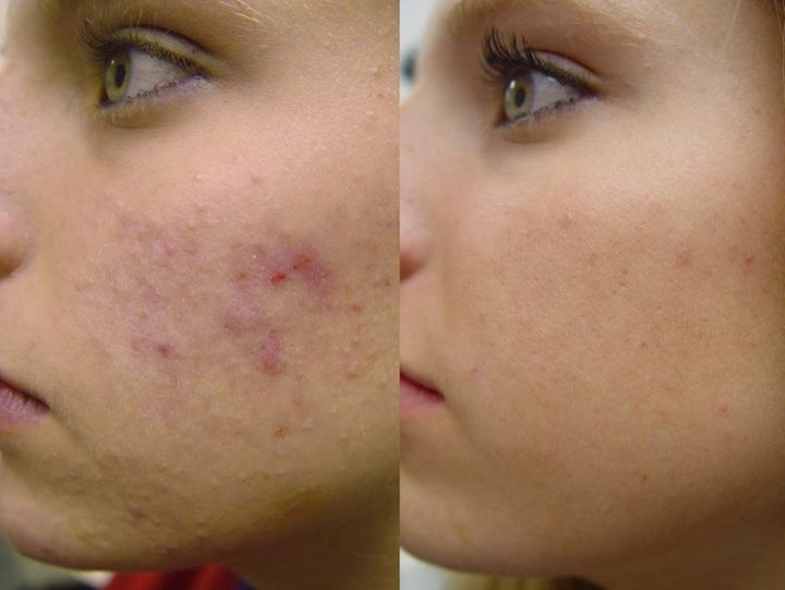 remédios naturais para eliminar a acne