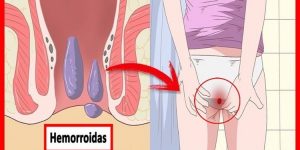 remédios caseiros para hemorroidas