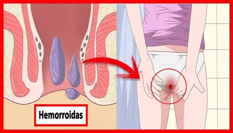 remédios caseiros para hemorroidas