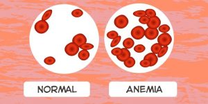 anemia