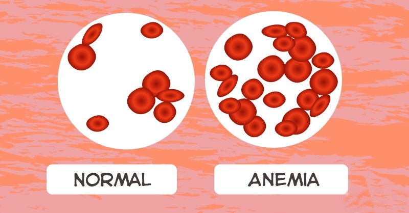 anemia