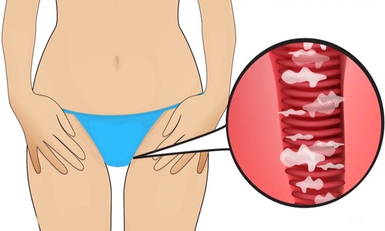 As 12 maneiras de tratar corrimento vaginal: como fazer e receitas