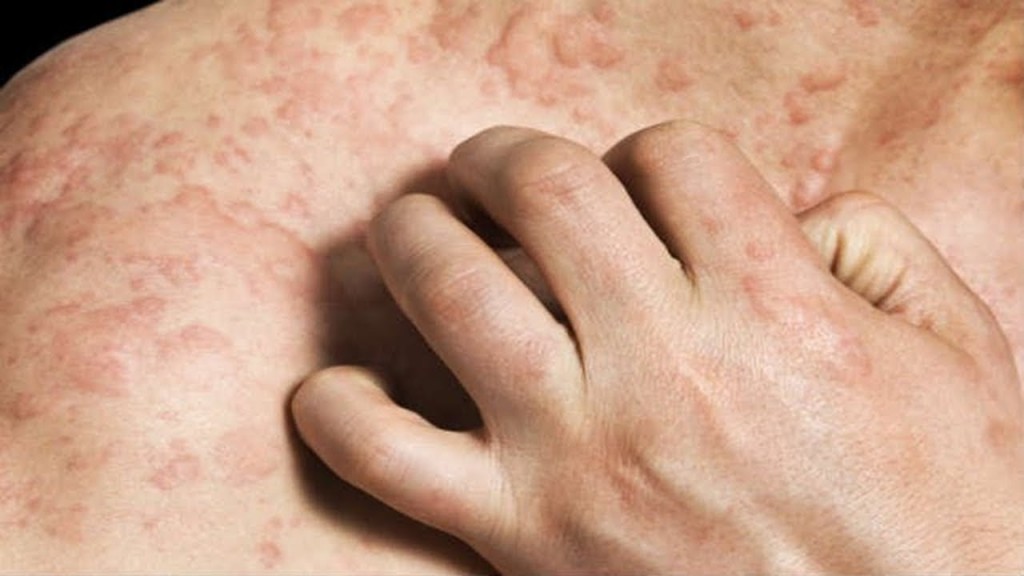 oleo de amendoas para eliminar a urticaria rapidamente