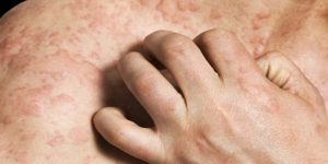 oleo de amendoas para eliminar a urticaria rapidamente