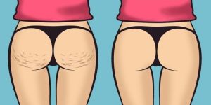 dicas para acabar com a celulite em casa