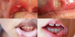combater a herpes labial