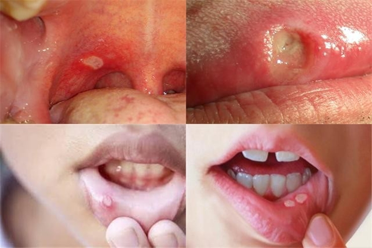 combater a herpes labial