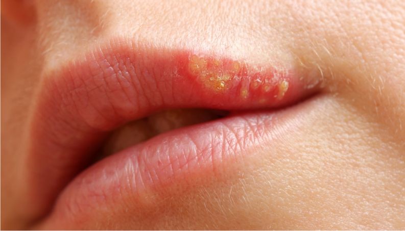 Os 6 remédios caseiros para combater a herpes labial: como fazer e dicas
