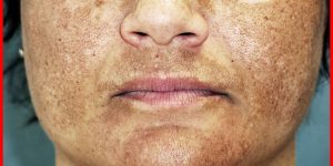 receitas caseiras para combater o melasma