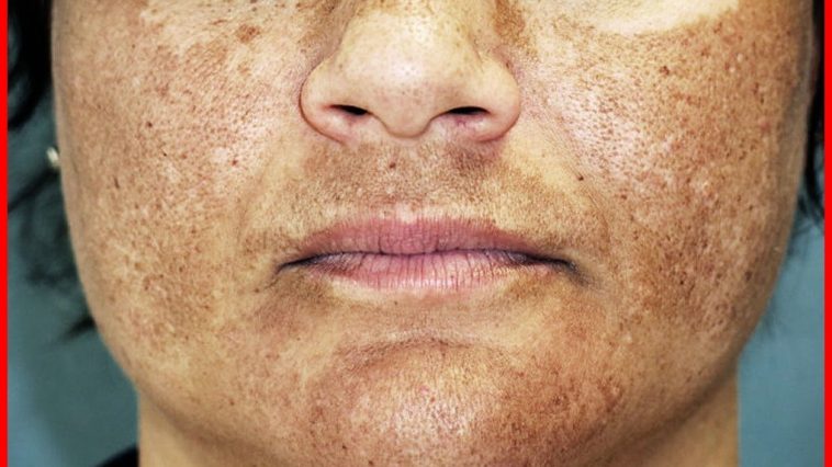 melasma