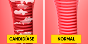 receitas caseiras para tratar a candidíase