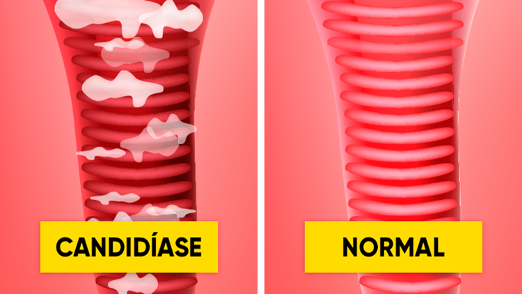 receitas caseiras para tratar a candidíase