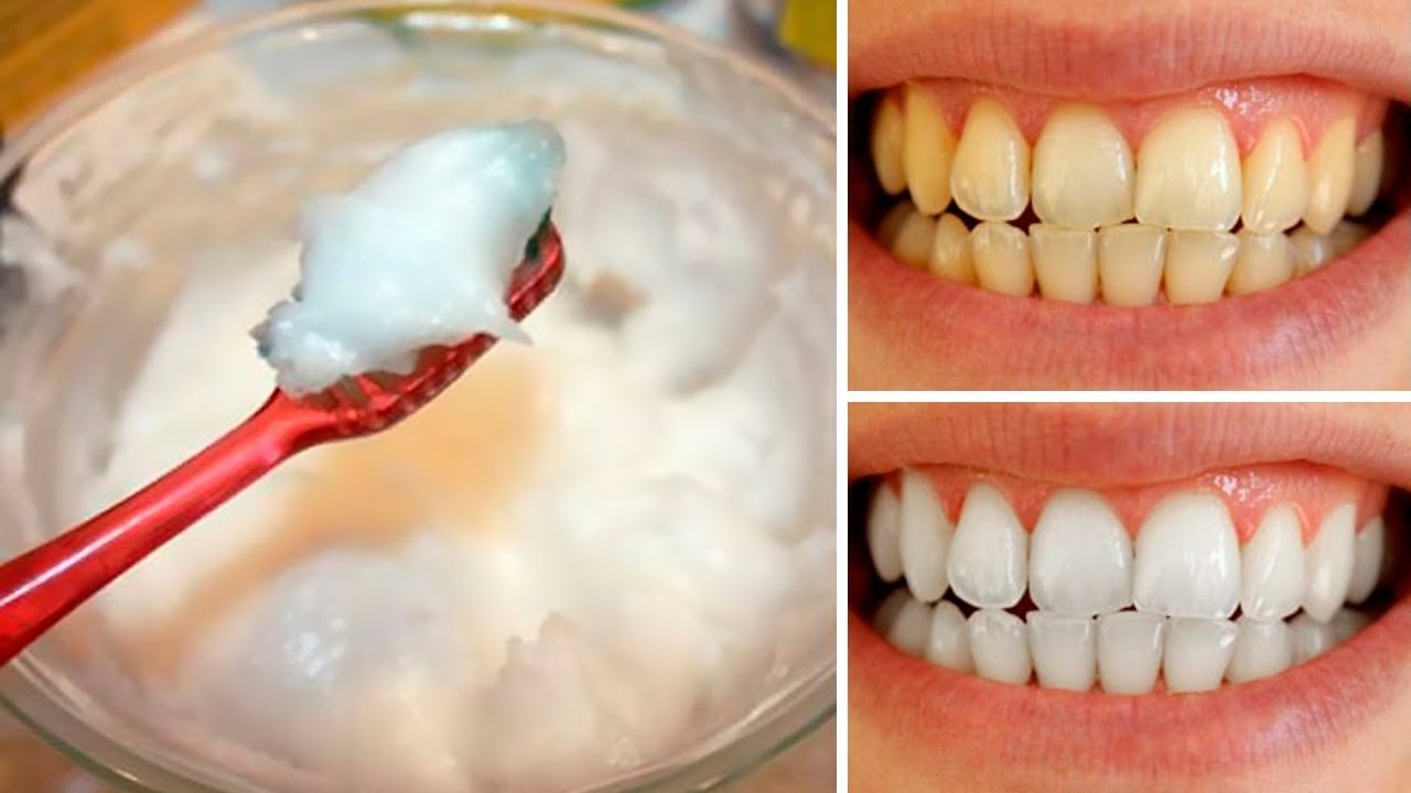 6 dicas naturais para clarear os dentes em casa: como fazer e receitas