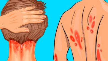 8 Sinais de Deficiência de Vitamina D no Organismo!