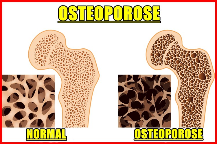 Osteoporose