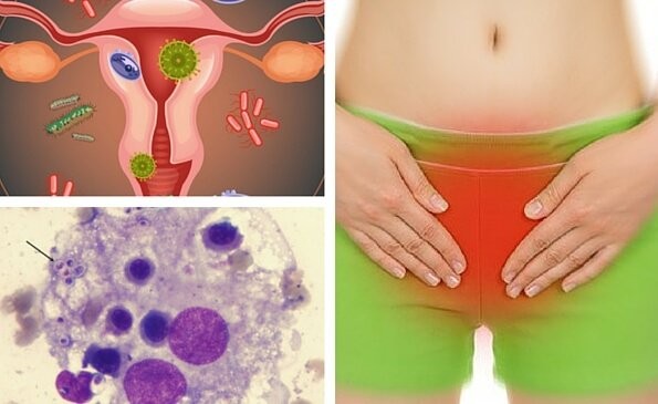 receitas naturais para eliminar infecção vaginal