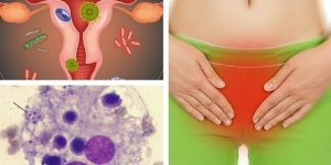 receitas naturais para eliminar infecção vaginal