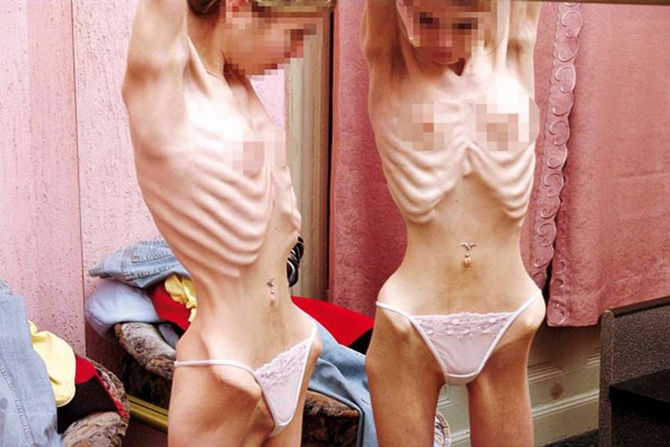 Os 9 principais sintomas de anorexia nervosa que poucos conhecem