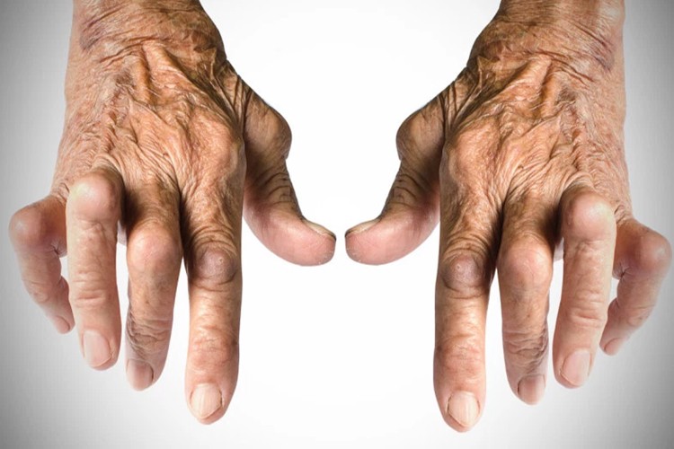 remedio caseiro para combater a artrite