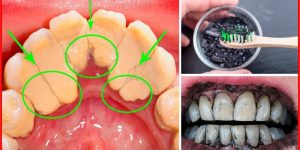 cremes caseiros para remover o tartaro dos dentes