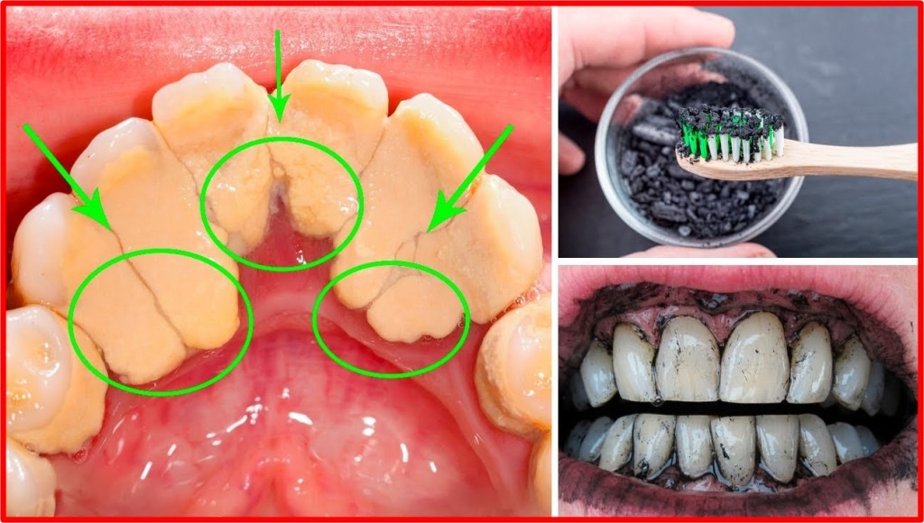 cremes caseiros para remover o tartaro dos dentes