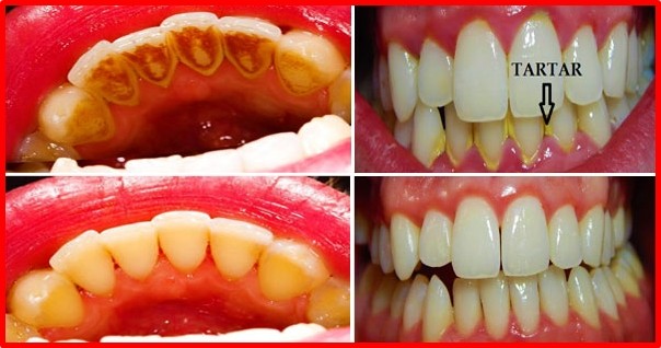 3 remédios caseiros para remover o tártaro e a placa bacteriana dos dentes