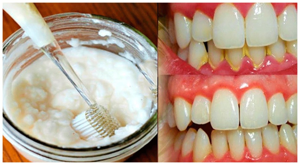 remedios naturais para remover o tartaro dos dentes