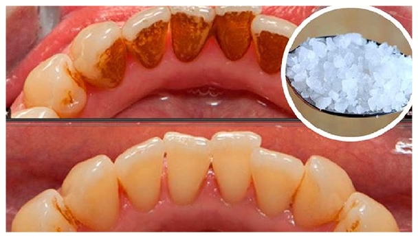 7 remédios caseiros para remover o tártaro dos dentes: receitas e dicas