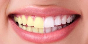 dicas para ter dentes brancos em minutos