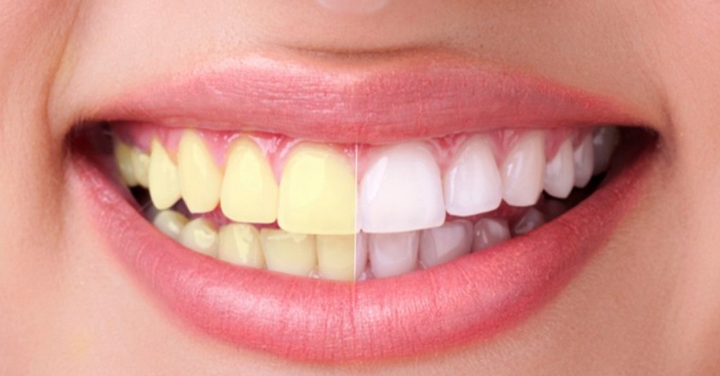 dicas para ter dentes brancos em minutos