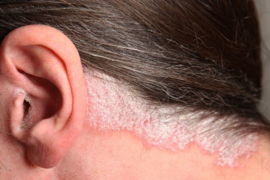 5 doenças do couro cabeludo e como combatê-las: receitas e dicas