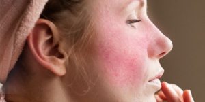 rosacea