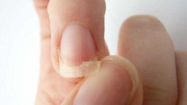 Unhas Frágeis e Quebradiças