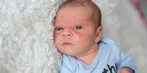 acne do bebê como prevenir