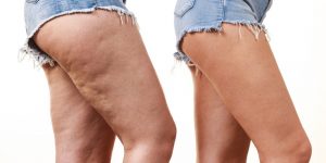 como remover a celulite das pernas naturalmente?