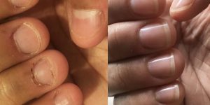 dicas eficazes de como parar de roer unhas