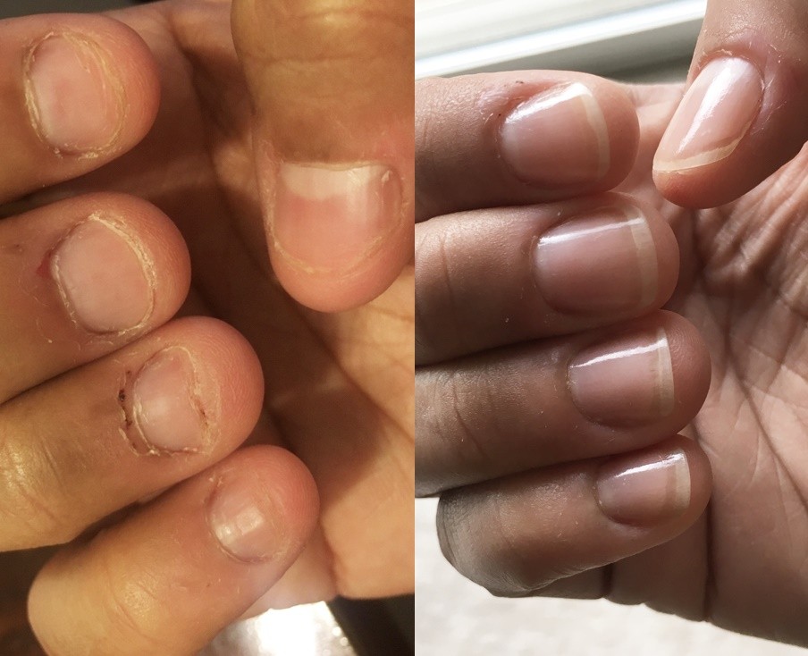 dicas eficazes de como parar de roer unhas