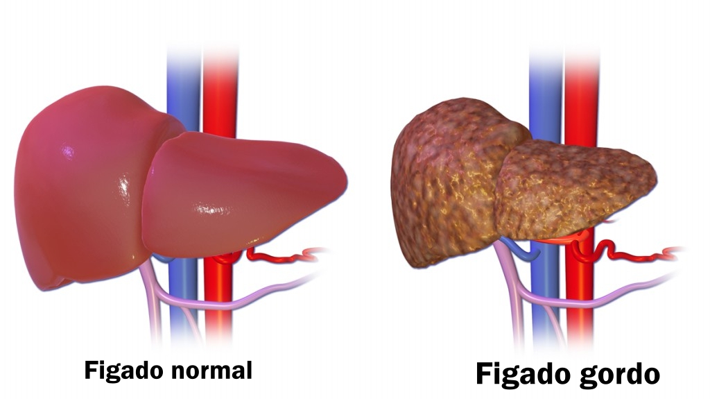 Fígado gordo: uma causa silenciosa do câncer de fígado