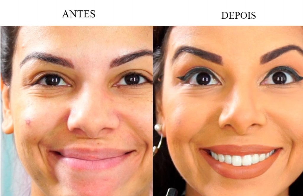 marcas de expressão facial