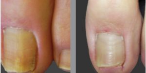 remover os fungos das unhas com vinagre