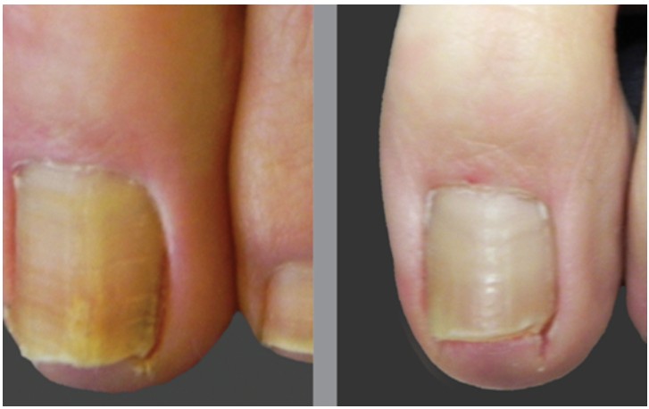 remover os fungos das unhas com vinagre