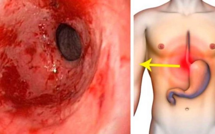 suco para curar acidez e refluxo