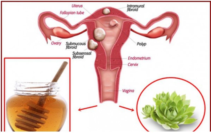 remédio caseiro para eliminar cistos e miomas