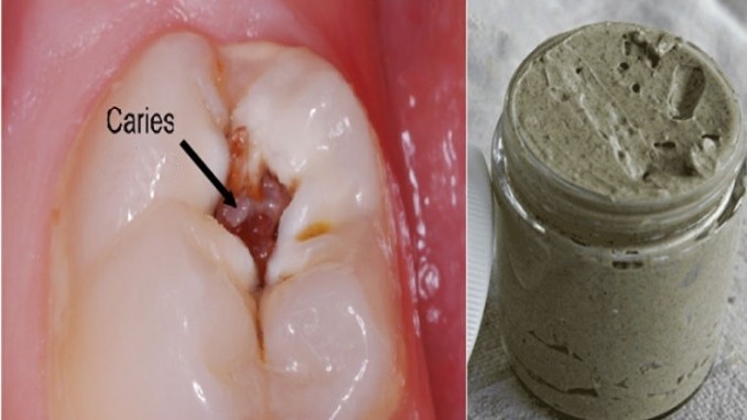 Creme dental natural para cáries, doenças gengivais e clarear os dentes