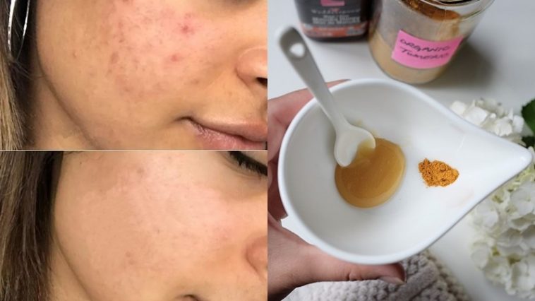 Mascaras Caseiras Para Inflamacao no Rosto