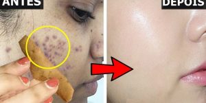 receitas para remover manchas faciais